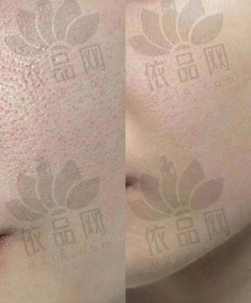 大庆超龙整形医院黄金微针项目优势