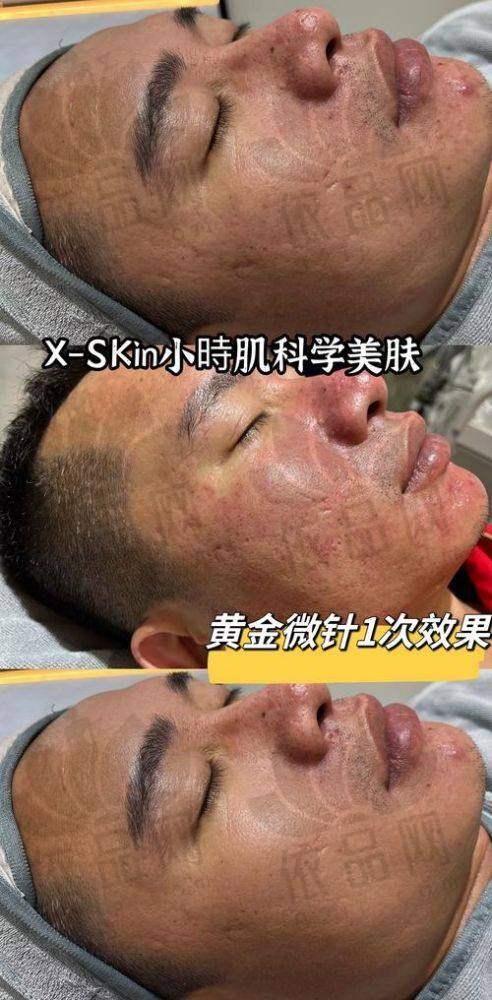 大庆超龙整形医院黄金微针项目价格