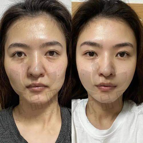 二、袁强博士拉皮手术水平如何