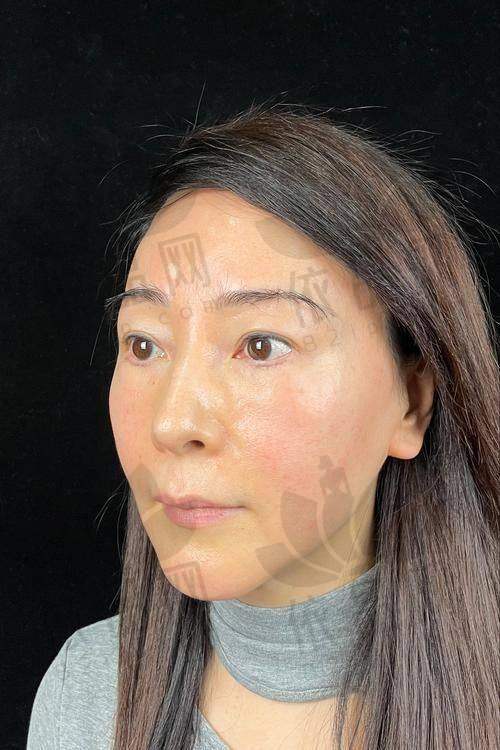 牡丹江君美施整形馒化脸修复的原则和方法