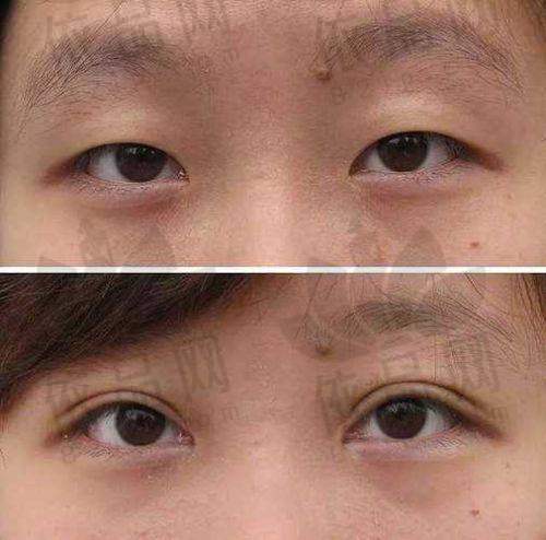 一、成都杨迪医生眼周筋膜提升怎么样？