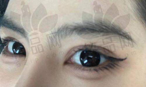 三、杨迪眼周筋膜提升实例分享：成效真实，维持时间久