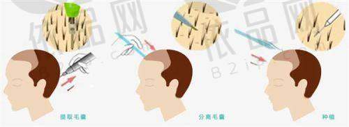 南京天际植发专科医院正规吗