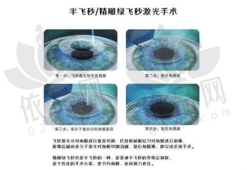 南京维视眼科ICL晶体植入手术29000元起，矫正高度近视，安全可逆视觉质量卓越