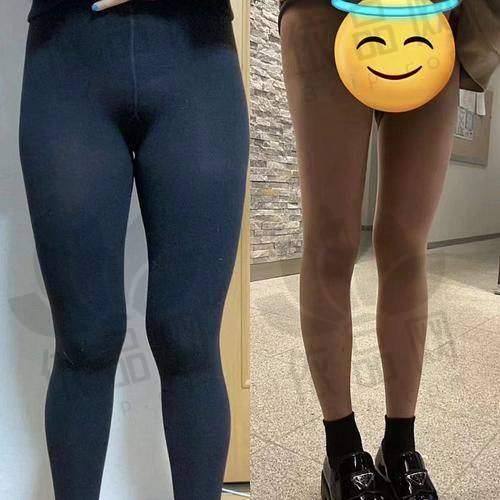 总之，南京连天美吴灏铭大腿吸脂是一项非常值得信赖的医美项目。如果你也想拥有一双纤细美腿，不妨选择南京连天美医院的吴灏铭医生，让他用不错的技术为你实现美丽梦想。相信在他的帮助下，你一定能够拥有令人羡慕的理想腿部线条。