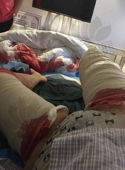 南京连天美吴灏铭大腿吸脂的价格