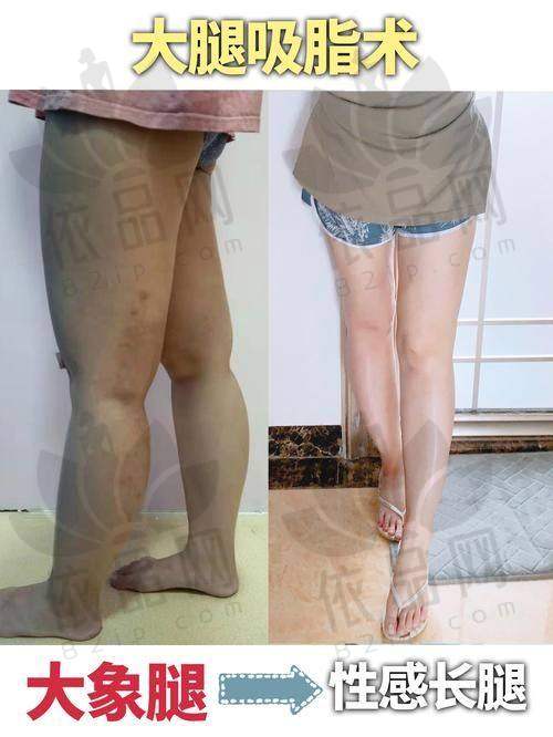 南京连天美吴灏铭大腿吸脂16900元起，精细技术助您轻松拥有纤细美腿！