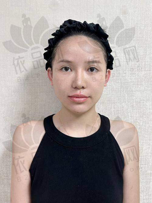 张越越医生注射幼态脸的擅长项目