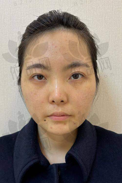 张越越医生注射幼态脸的优势