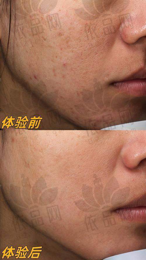 南京美贝尔光子嫩肤低至581元起，设备优医生强，多次操作肌肤细腻效果佳