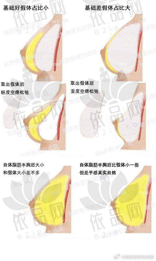 南京美贝尔黄名斗做曼托假体隆胸18000元起，创伤小恢复快，术后胸型稳定手感真实