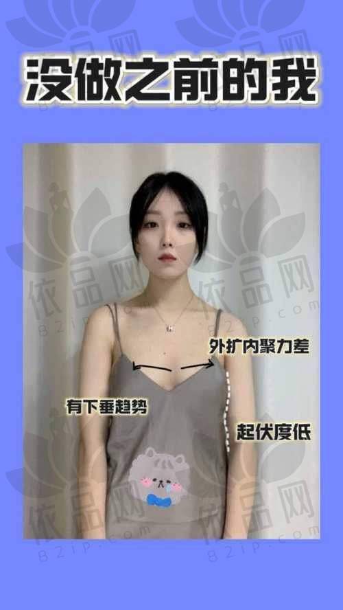 曼托假体隆胸项目价格