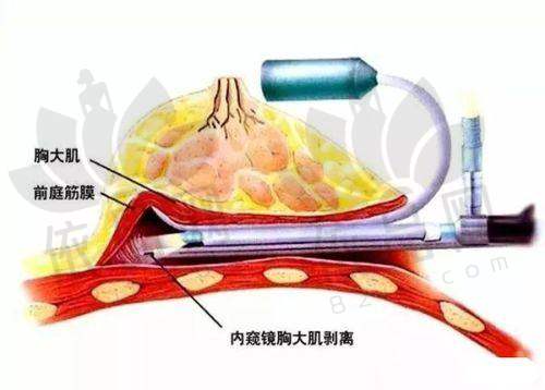 选择无锡施尔美姚义超假体隆胸的理由总结