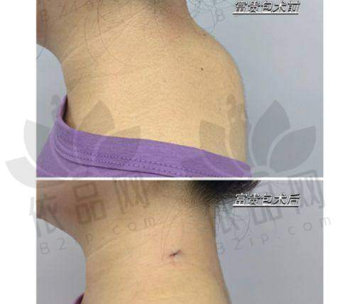 二、温州艺星徐淑卿医生富贵包手术技术强大