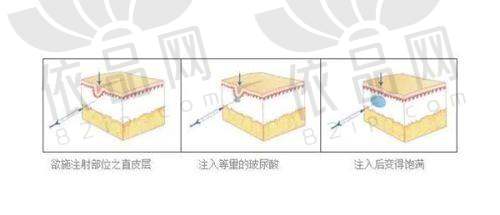 南京伊而菲斯徐劲松内轮廓苹果肌复位提升的优势