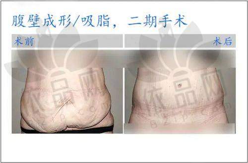 四、南京嘉怡美卓然大腿吸脂的价格
