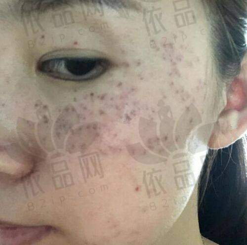 重庆西 南医院整形科激光祛斑治疗成效