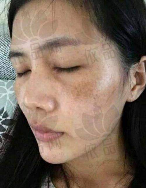 三、南京嘉怡美贺伶俐激光祛斑的优势
