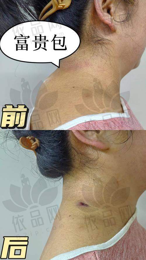 一、徐淑卿医生做富贵包手术实例反馈佳
