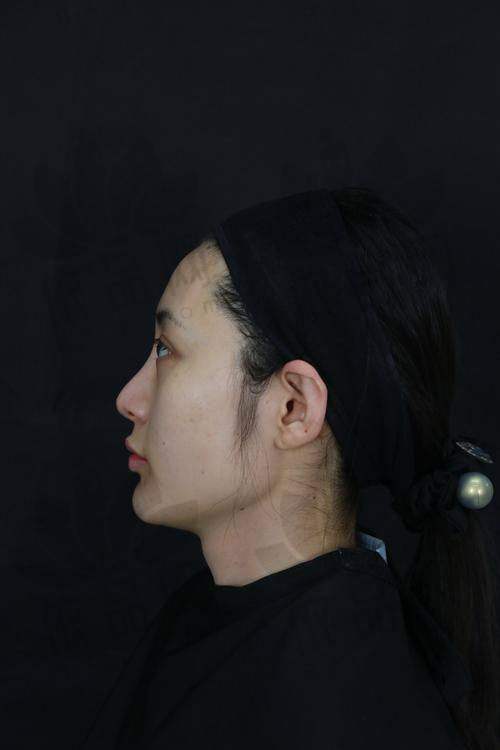 南京鼻祖王刚双子塔鼻综合29800元起，效果自然立体，独创技术鼻头揉捏不变形