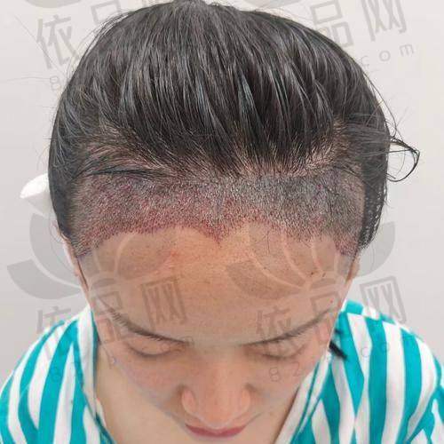 南京伊而菲斯柯维医生种发际线18000元起，术后自然无痕，毛囊密度均匀效果佳