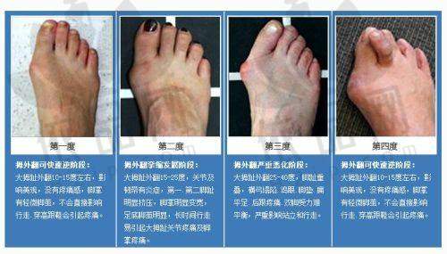 超光子治疗过程及成效