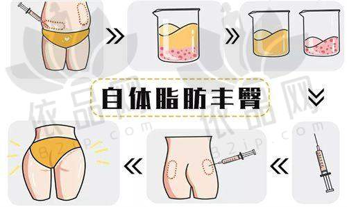 钟伟洪医生大腿吸脂口碑评价