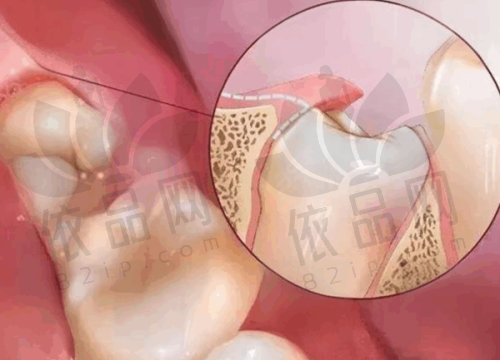 宜兴牙牙康口腔根管治疗的价格