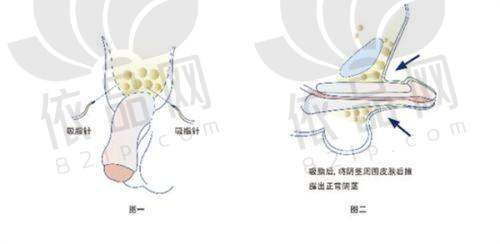 五、选择无锡丽都整形李松泽PARK法无痕双眼皮的理由
