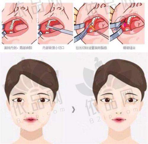 朱武根医生——美杜莎综合美眼术的骨干医生