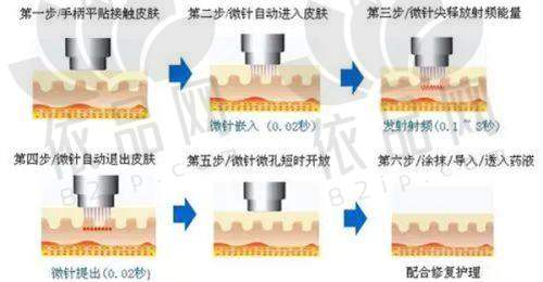 无锡华韩美容半岛黄金微针项目价格