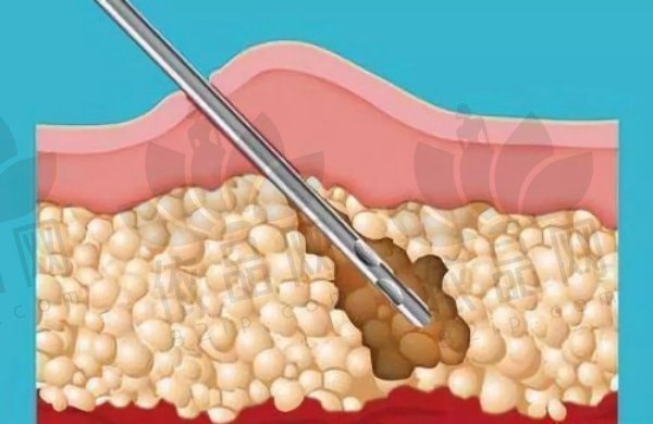 深圳米兰柏羽钟伟洪大腿吸脂1.2w元起，多技术塑形，术后腿围缩小效果显著！