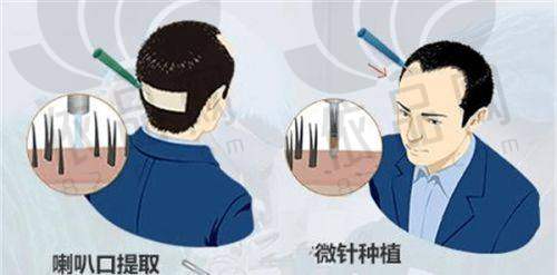徐州医科汇美沈晓冬头顶加密种植15000元起，多种技术成果自然，发友口碑好！