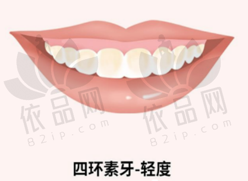 苏州拜博口腔爱尔创全瓷牙仅1468元起，美观协调、生物相容佳，修复效果超棒