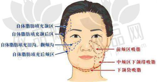 艾维岚童颜针：液态热玛吉的魅力
