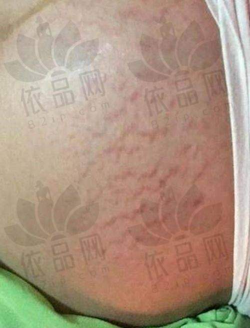 总之，苏州乐桥疤痕专科凭借其娴熟的技术、丰富的经验、透明的收费以及专精的医生团队，在妊娠纹修复方面有着独特的优势。刘彦玲医生9800元起用激光微针修复妊娠纹，并且注重保护皮肤屏障，为众多受妊娠纹困扰的女性带来了福音。如果你也正在为妊娠纹问题而烦恼，不妨考虑一下苏州乐桥疤痕专科，相信他们能够帮助你改善皮肤状况，重拾自信。