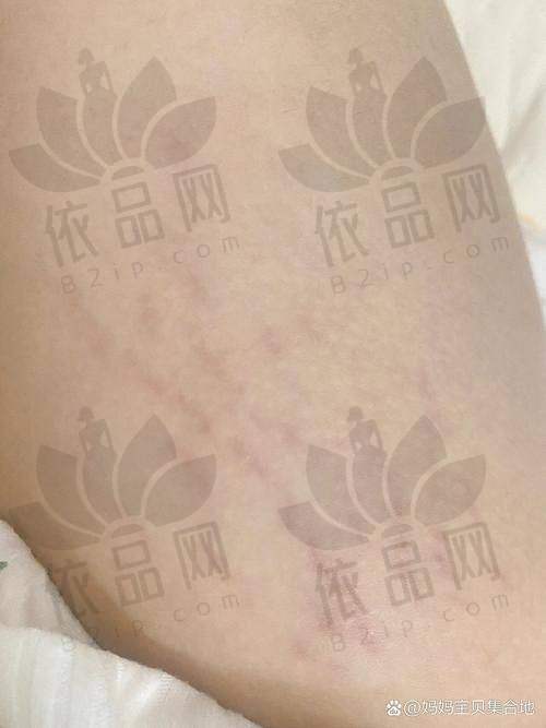 苏州乐桥疤痕专科妊娠纹修复技术与方法