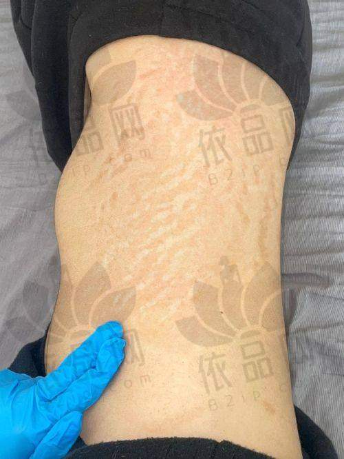 苏州乐桥疤痕专科刘彦玲医生