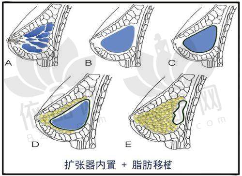 双眼皮手术的过程和注意事项