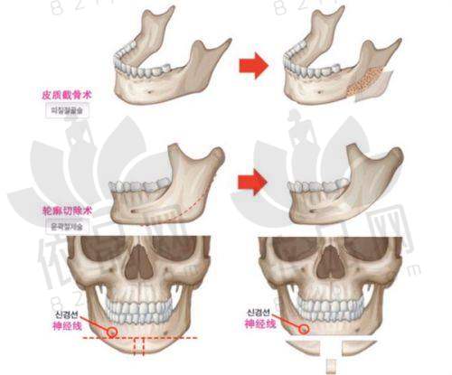馒化脸修复实例分享