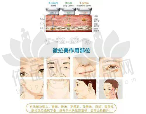 选择庄雅云医生做双眼皮手术的理由