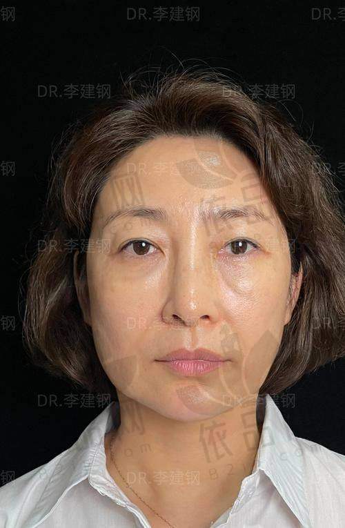 苹果肌复位，法令纹改善，轻松找回十年前