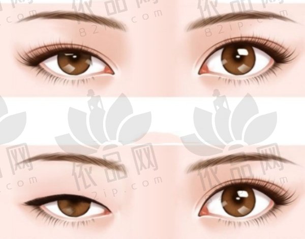 广州韩妃李光琴双眼皮手术效果好吗？技术出色成效自然附术前术后惊艳对比照