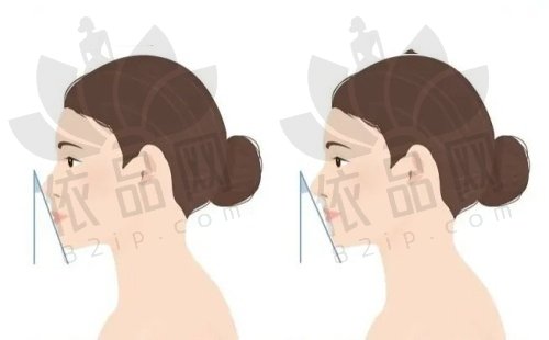 广州美恩周会喜正颌手术案例展示，收费48800元起速来了解