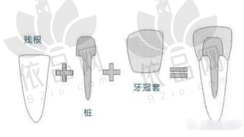 镇江古德堡口腔瑞士ITI种植牙12000元起/颗，骨增量黑科技，牙龈重塑接近天然牙
