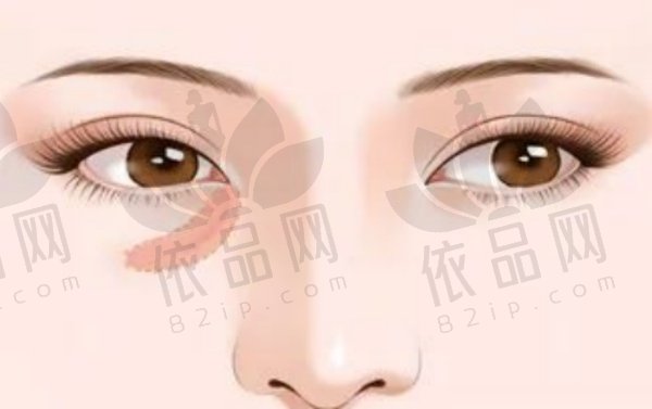 郑州王杨医生是有名的眼部整形专家，个性化方案打造自然持久美眼成效