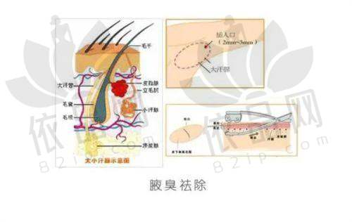 杭州维多利亚马腾抽脂价格
