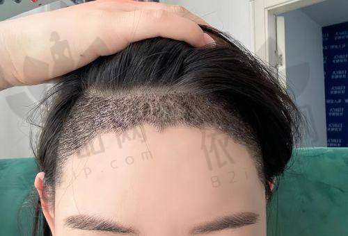 泰州友谊整形郭楠楠发际线种植项目的优势