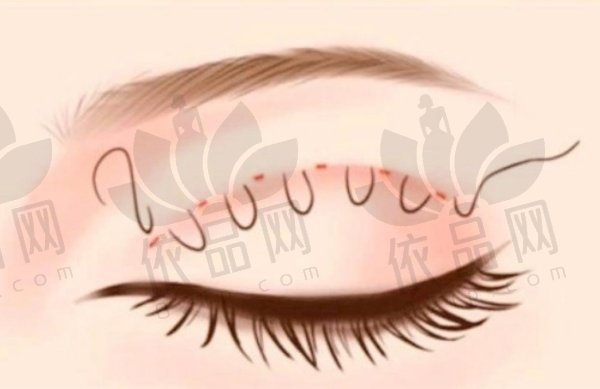 宿迁奕美美容医院刘琳做双眼皮3800元起，个性化方案，10年经验打造灵动双眸