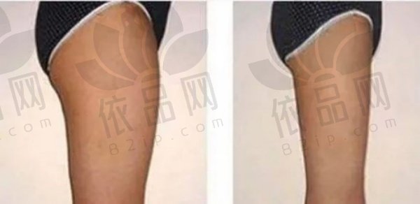 冯斌脂雕项目深度解析：特色技术、多元项目及精细吸脂手术流程